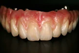 The award-winning aesthetic implant case, photographed on black