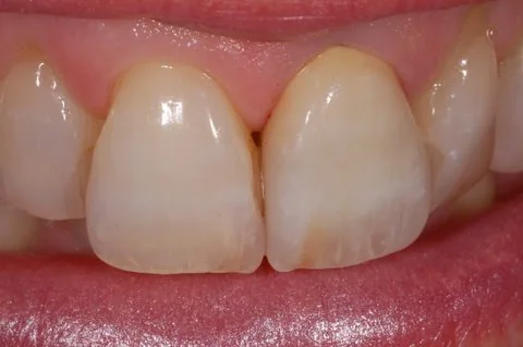 All-ceramic crown on an upper front tooth, in the mouth