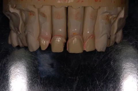 All-ceramic anterior veneers on the model