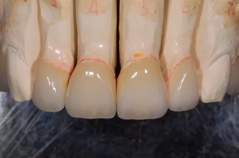 Anterior veneers, all ceramic