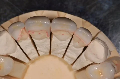 Anterior veneers arranged on the model
