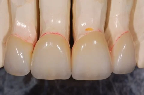 Anterior veneers, all ceramic