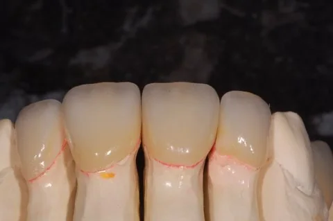 Anterior veneers, all ceramic
