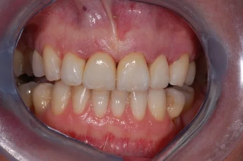 Anterior veneers, all ceramic