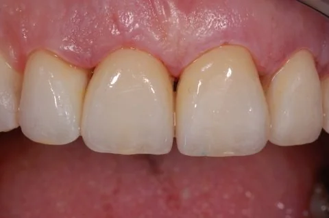 Anterior veneers, all ceramic