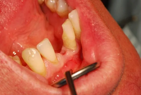 Case photograph: the lower teeth and gum, with the lip held back by a retractor