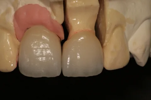 Two crowns on the working model, with pink gum material at the neck of one