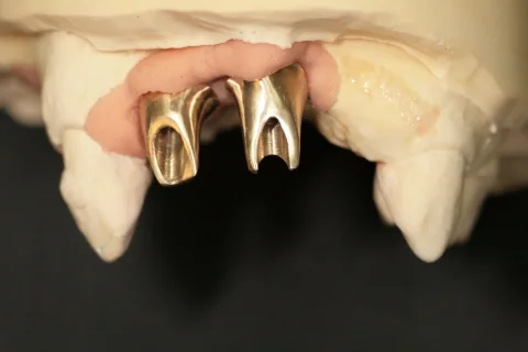 Two gold-coloured metal copings on the working model