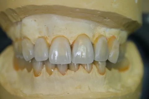 Diagnostic wax-up on the model, front view