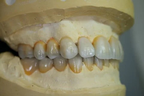 Diagnostic wax up. Anterior right