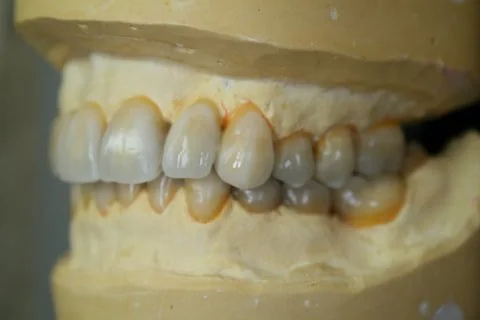 Diagnostic wax up. Anterior left