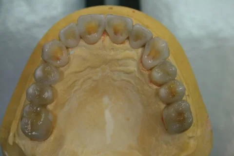 Diagnostic wax up. Upper occlusal