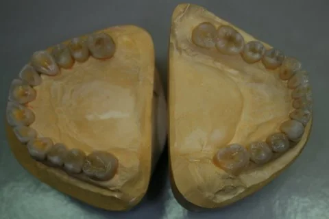 Diagnostic wax up. Upper and lower occlusal