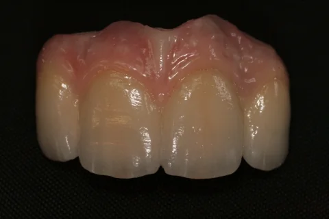 Four-unit implant bridge with pink porcelain gum work