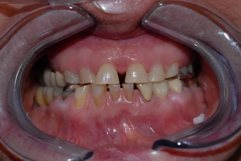 Full upper and lower all-ceramic restoration (Lava). Before treatment