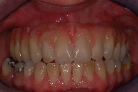 Full upper implant bridge