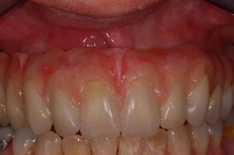 Full upper implant bridge