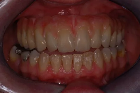 Full upper implant bridge