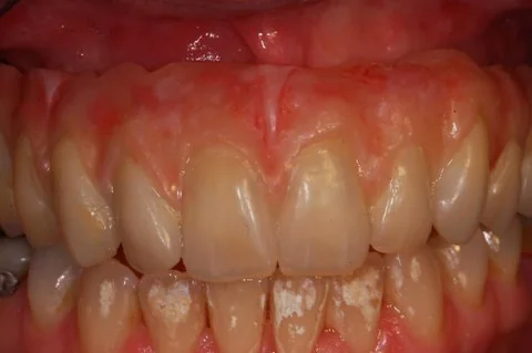 Full upper implant bridge