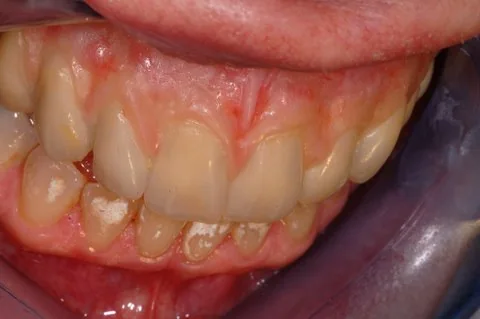Full upper implant bridge