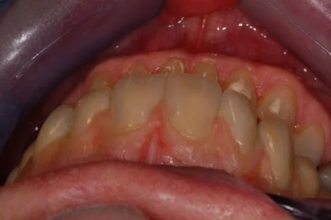 Full upper implant bridge