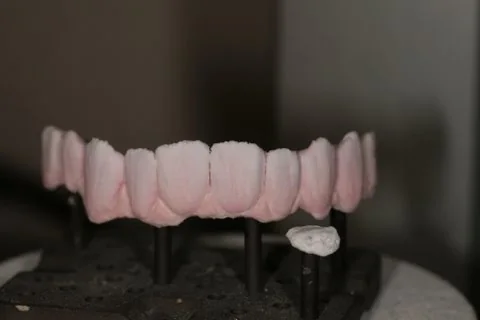 Full upper implant bridge