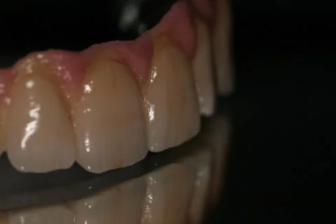 Full upper implant bridge