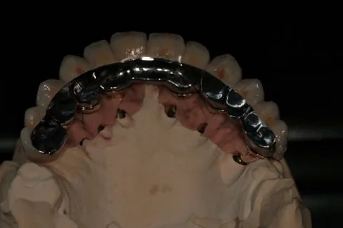 Full upper implant bridge