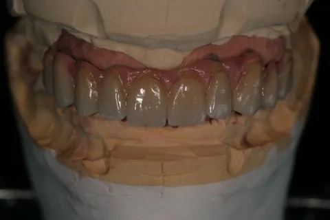 Full upper implant bridge