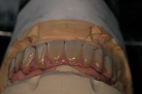 Full upper implant bridge