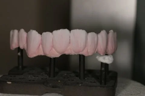 Full upper implant bridge on the implant model