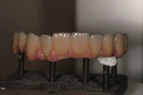 Full upper implant bridge