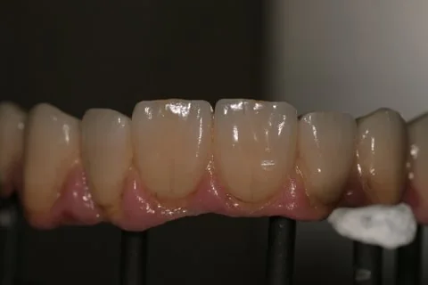 Full upper implant bridge