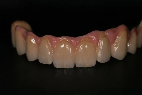 Full upper implant bridge