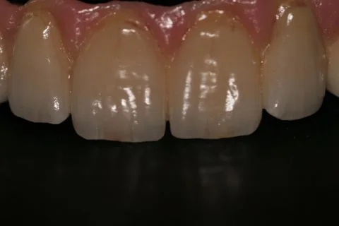 Full upper implant bridge, photographed on black