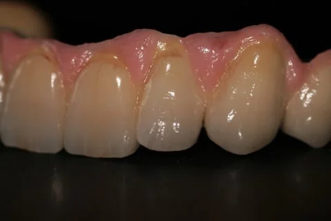Full upper implant bridge