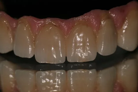 Full upper implant bridge