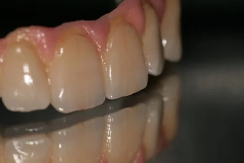 Full upper implant bridge