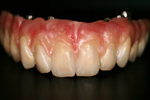 Full upper implant bridge in the mouth