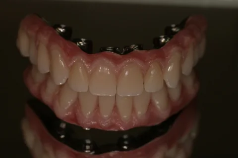 Full upper and lower implant dentures on milled titanium beams