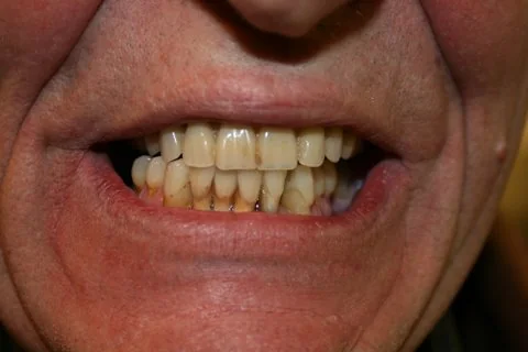 Lower Maryland bridge, porcelain bonded to non-precious metal. After