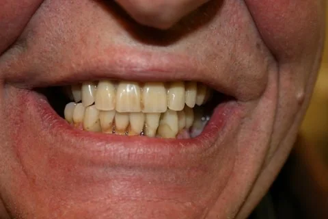 Lower Maryland bridge, porcelain bonded to non-precious metal. After