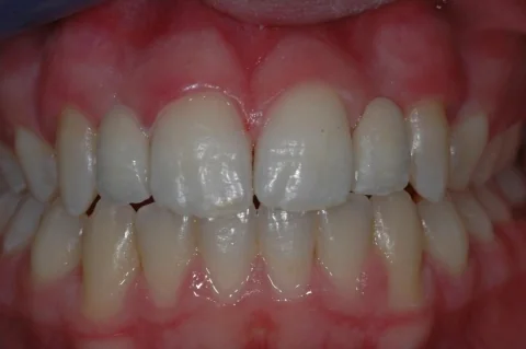 Maryland (resin-bonded) bridges, lateral teeth. Post op