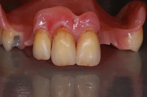 Highly customised partial upper denture