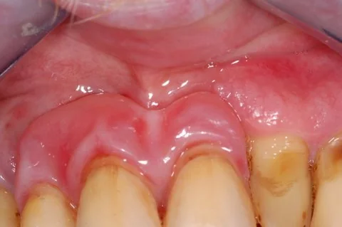 Partial upper denture