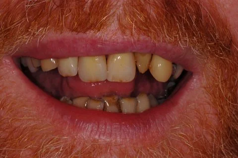 Partial upper denture