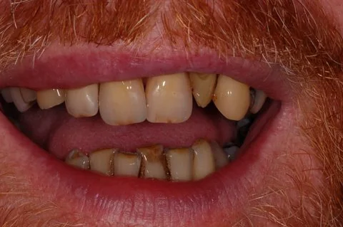 Partial upper denture