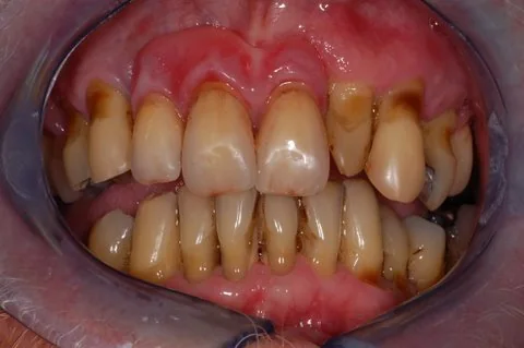 Partial upper denture
