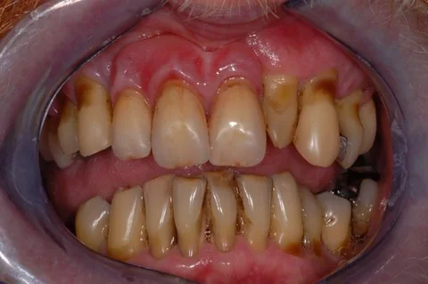 Partial upper denture