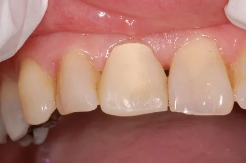 Upper right all-ceramic crown. Before